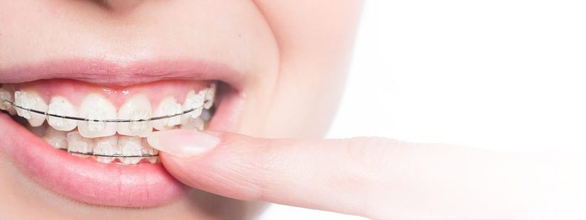 Orthodontic braces Brunswick