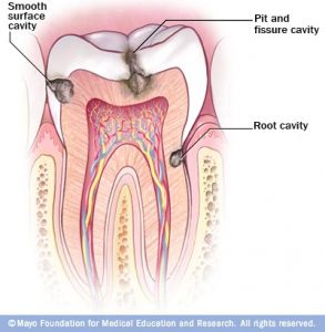 Signs of infected tooth pulp