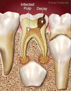 infected tooth pulp